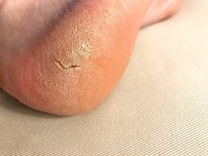 warts on foot left untreated papilomul pleoapei superioare